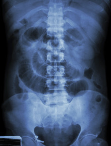 "Small intestine obstruction" Film X-ray abdomen supine : Show small intestine dilate